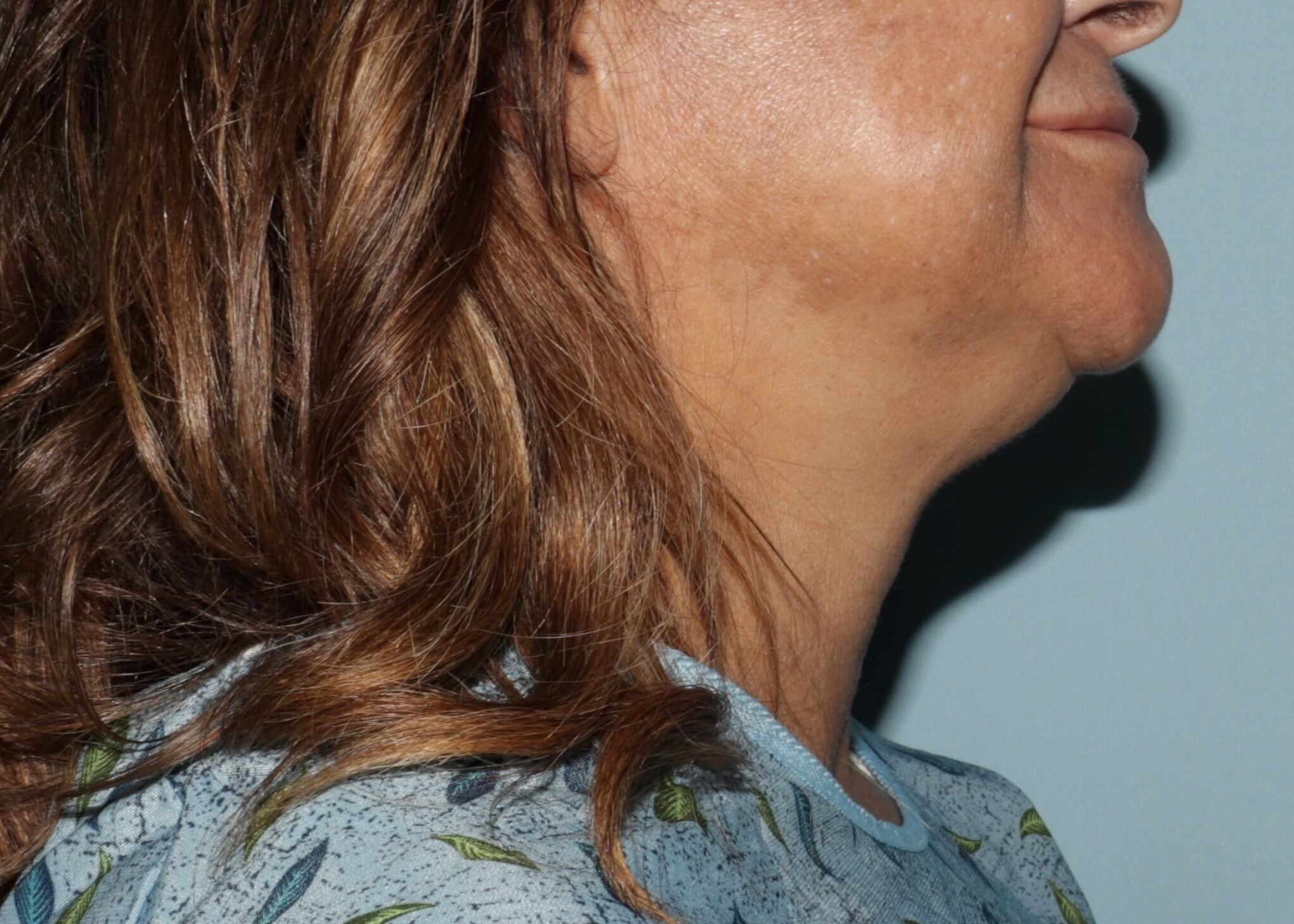 Preoperative side view